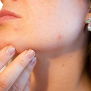 Quick Natural Remedies for Acne Scar Removal in a Week