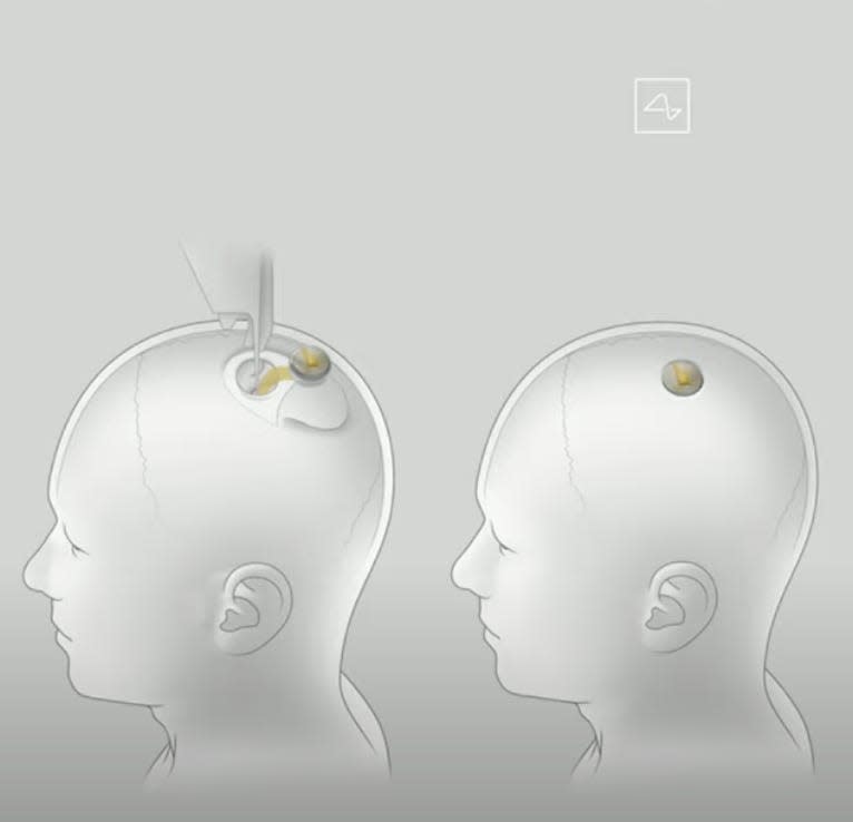 A diagram shows the surgical procedure to insert a Neuralink brain chip into a human patient's skull.